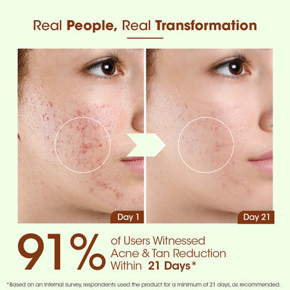LAXAST Eladi Acne Control Combo